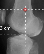 trac.femur